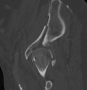 Acetabular Fractur Non concentric 1